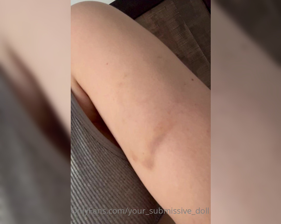 Your_submissive_doll - (Valorie) - Good morning!! Here’s my bite update it’s almost gone