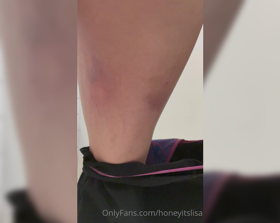 Honey Its Lisa aka honeyitslisa OnlyFans - Can someone tell me what these bites are and why they are brusessssyy